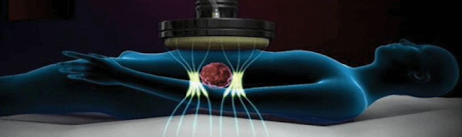 tratamiento con Oncothermia visto en 3 dimensiones