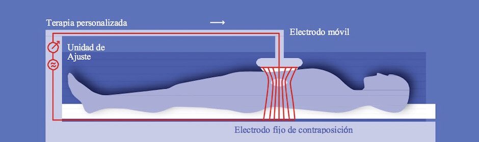 Esquema de tratamiento con Oncothermia