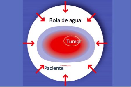 Hipertemia convencional