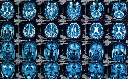 Glioma cáncer de cerebro