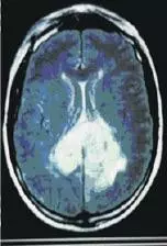 Cáncer de cerebro