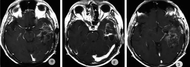 Cáncer de cerebro