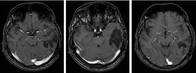 Cáncer de cerebro