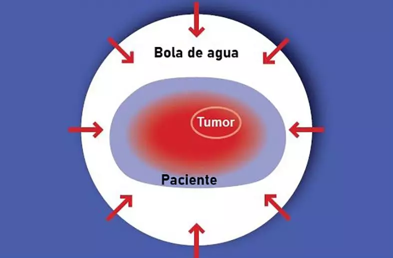 Efectos Oncothermia