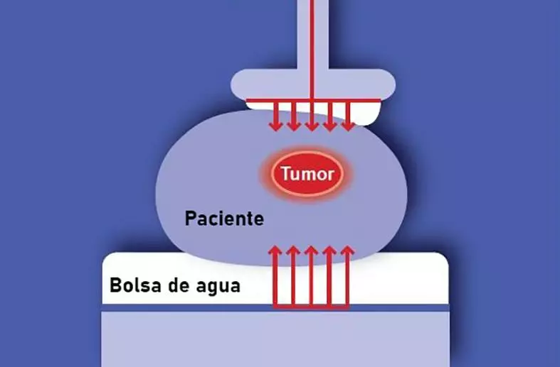 Efectos Oncothermia