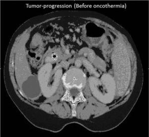 Cáncer Hepatobiliar