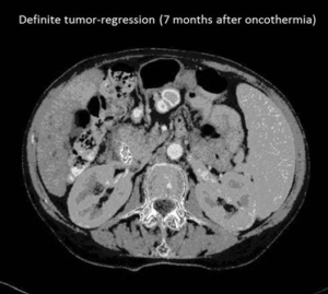 Cáncer Hepatobiliar