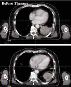 Cáncer de pulmón