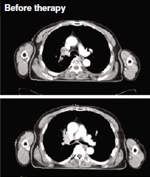 Cáncer de pulmón