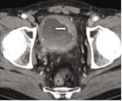 Cáncer de vejiga urinaria