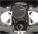 Cáncer de vejiga urinaria